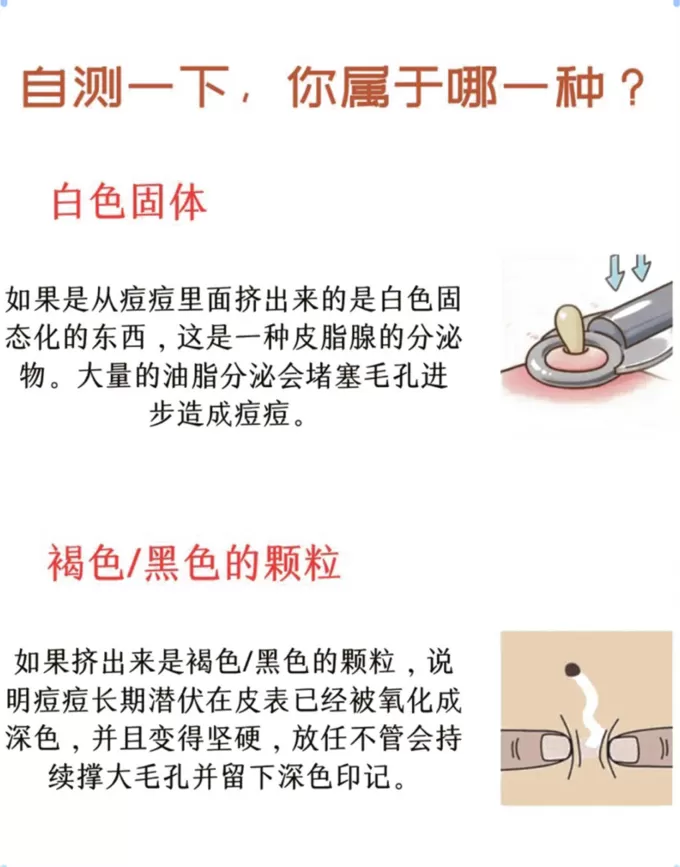 💗进来自测一下吧!你的痘.痘挤出来是什么?